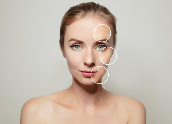 A Guide to Acne Pigmentation